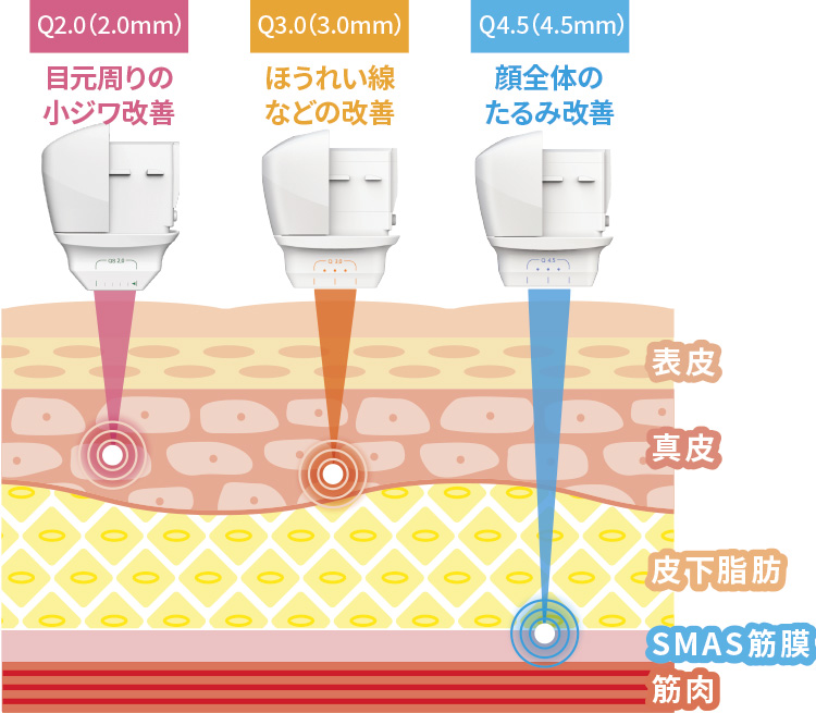 Q1.5(1.5mm)目元・口元のシワ改善 Q3.0(3.0mm)ほうれい線などの改善 Q4.5(4.5mm)顔全体のたるみ改善