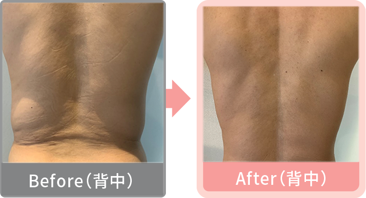 症例写真 背中
