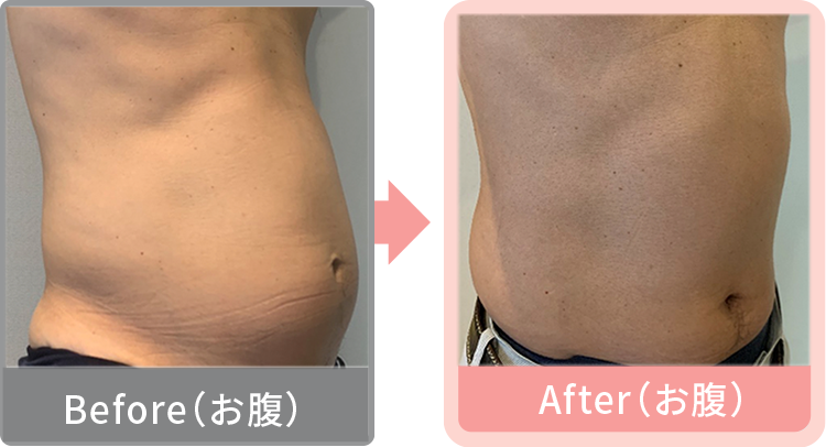 症例写真 お腹