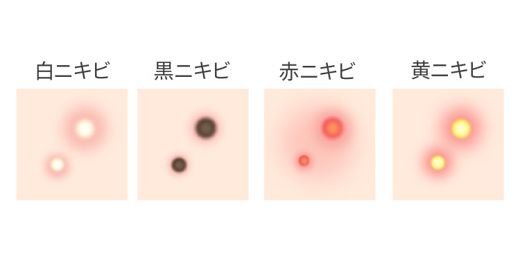 今できているニキビも治す