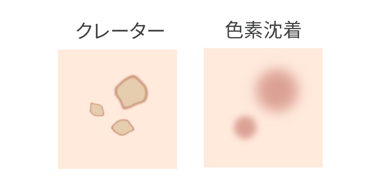 ニキビ跡による肌のデコボコも改善
