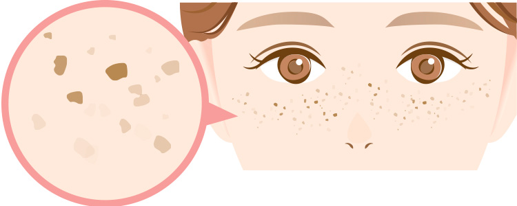 そばかす(雀卵斑)